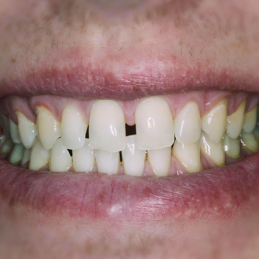 dental bonding - smile 1 - before - 3Dental
